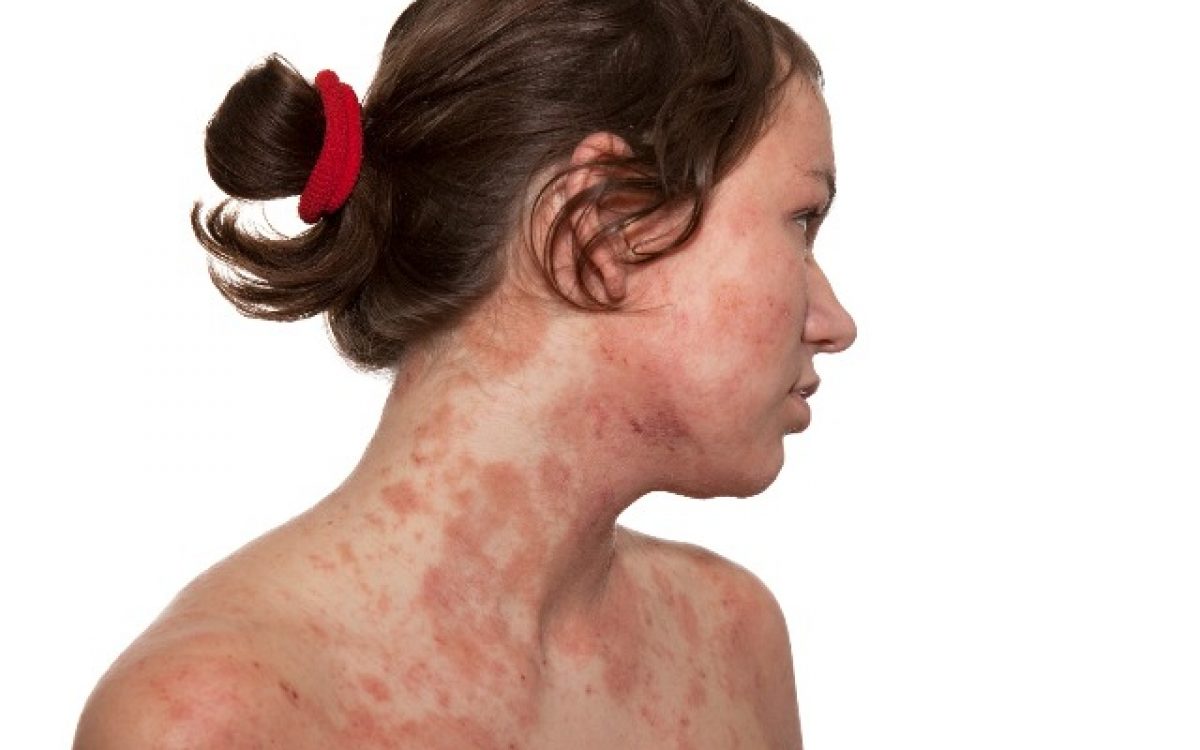 Inverno e Dermatite Atópica: dermatologista explica como proteger a pele durante os dias frios
